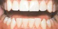 Beyazlatılmış Dişler