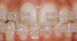 Estetik Ortodonti