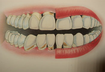 Diş Eti Çekilmesi Hastalığı ve Tedavisi, Periodontoloji, dişeti ameliyatı